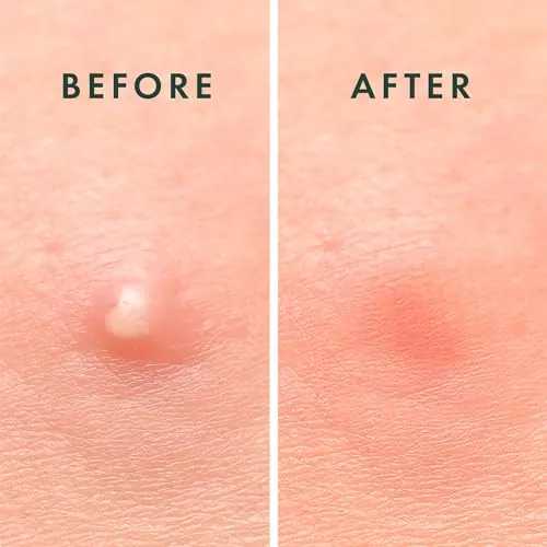 Rael Pimple Patches Review: Invisible Hydrocolloid Patch image 5