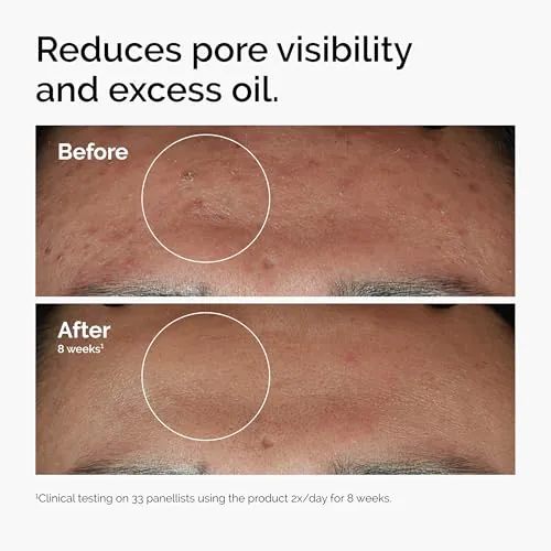 The Ordinary Niacinamide 10% + Zinc 1% Serum Review image 2